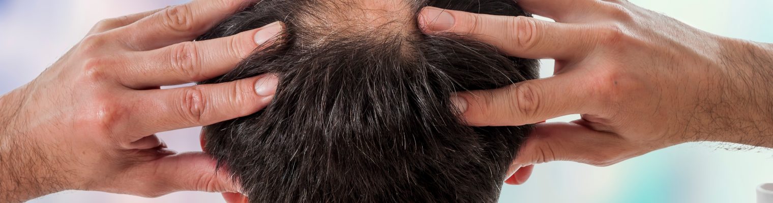 Understanding Hair Loss: Common Causes and Treatments