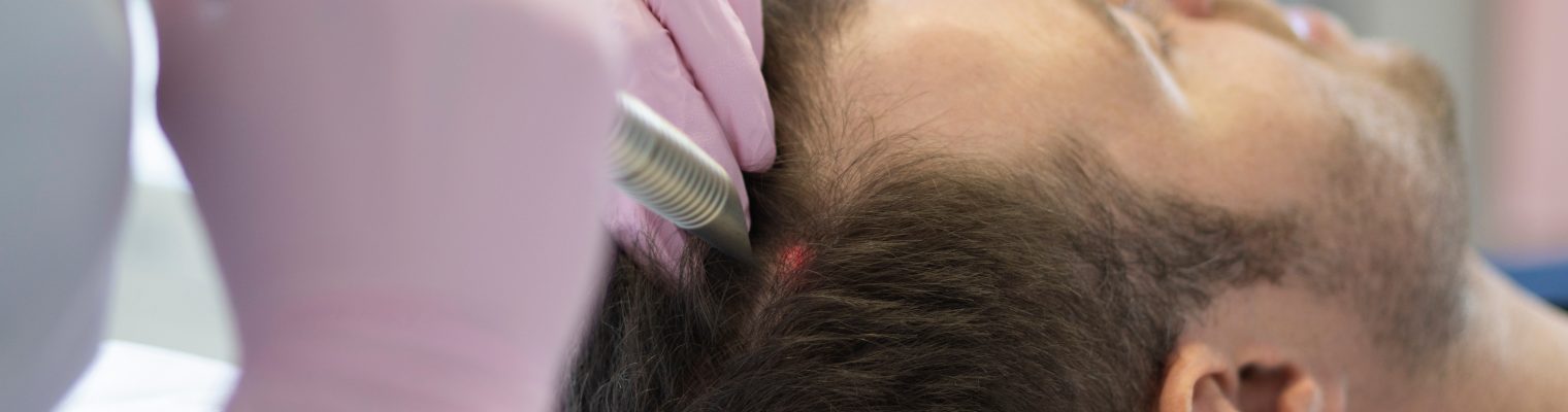 Hair Rejuvenation vs. Hair Transplants: Which Is Right for You?